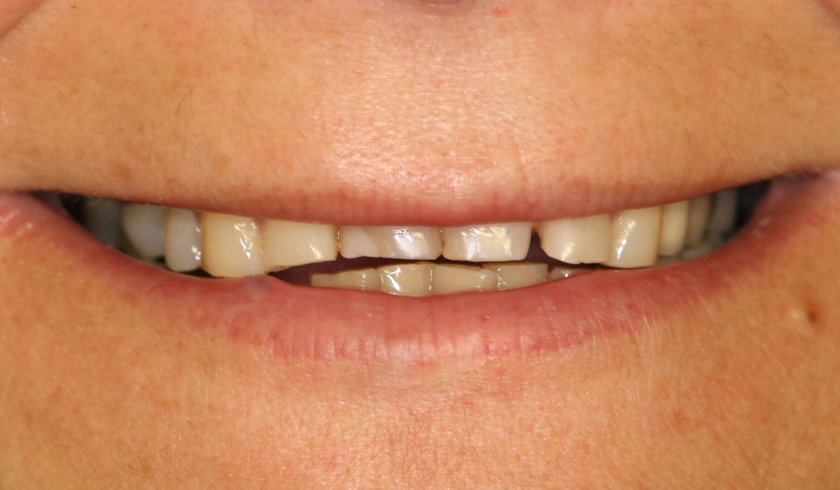 zubi prije smile makovera