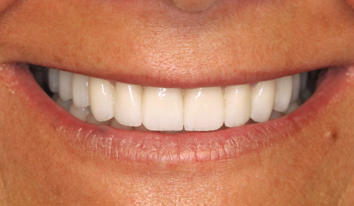 osmijeh nakon smile makeovera u style your smile ordinaciji, zagreb